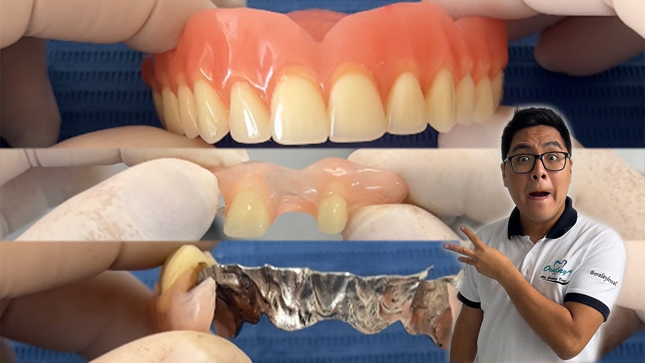 La mejor prótesis para devolver dientes #protesisdental #shorts #viral