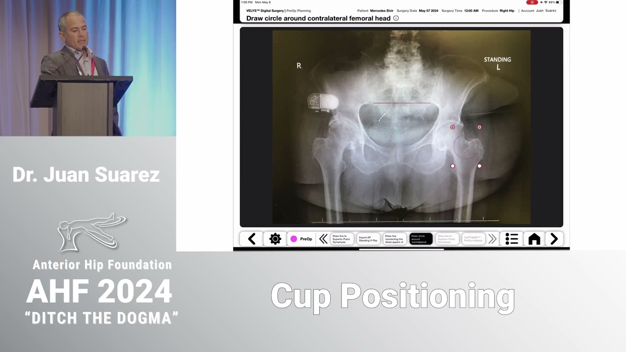 Cup Positioning | Dr. Juan Suarez | AHF 2024