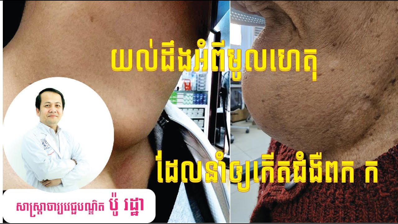 យល់ដឹងអំពីមូលហេតុដែលនាំឲ្យកើតជំងឺពកក