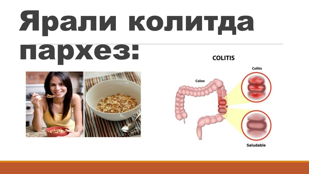 ярали колитда пархез