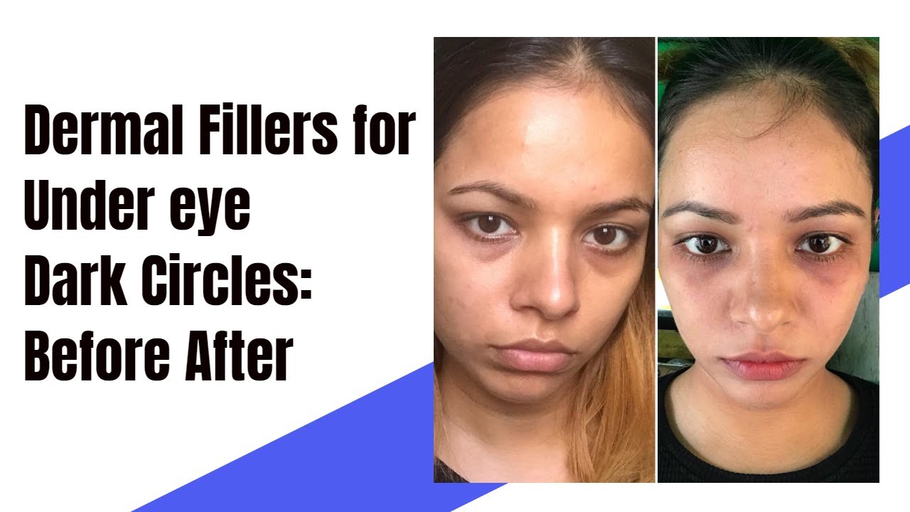 Dermal Fillers in Delhi | Face filler before and after| Undereye filler| Undereye circle treatment