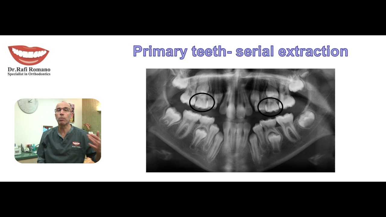 Dr. Rafi Romano- Serial Extraction of primary teeth