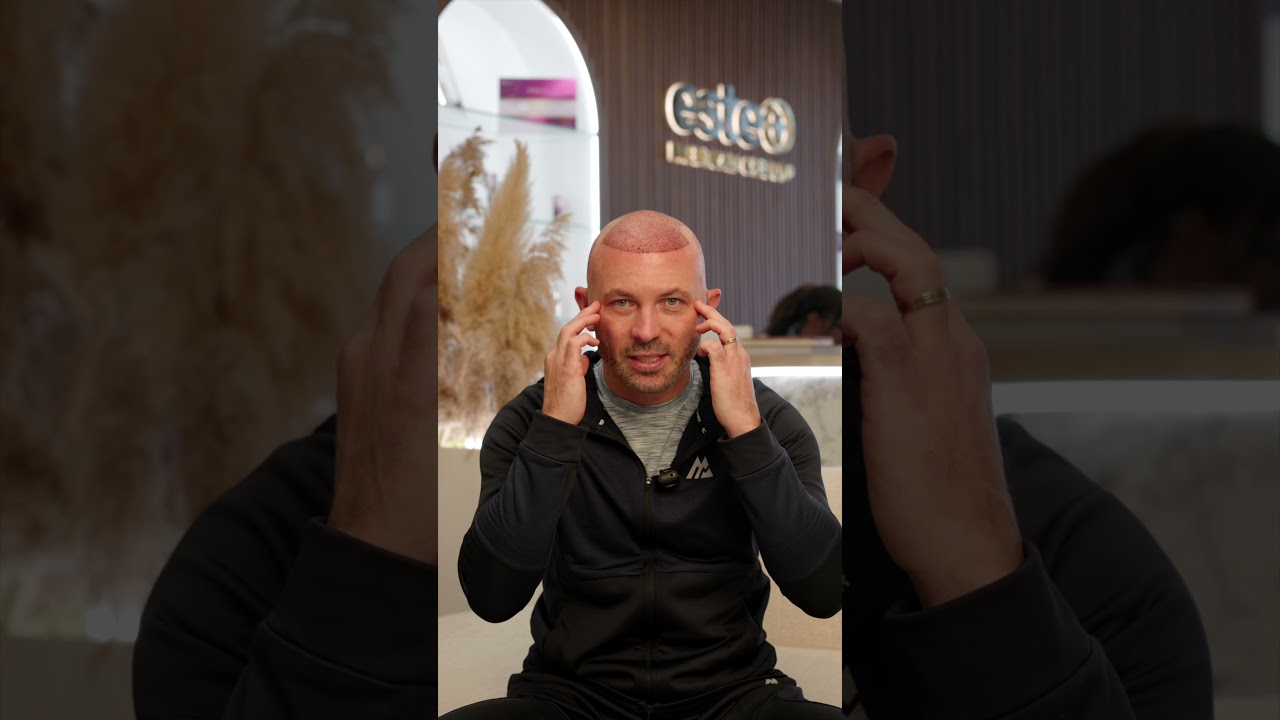 3 Days After My Hair Transplant at Este Medical | Phil Bardsley Update