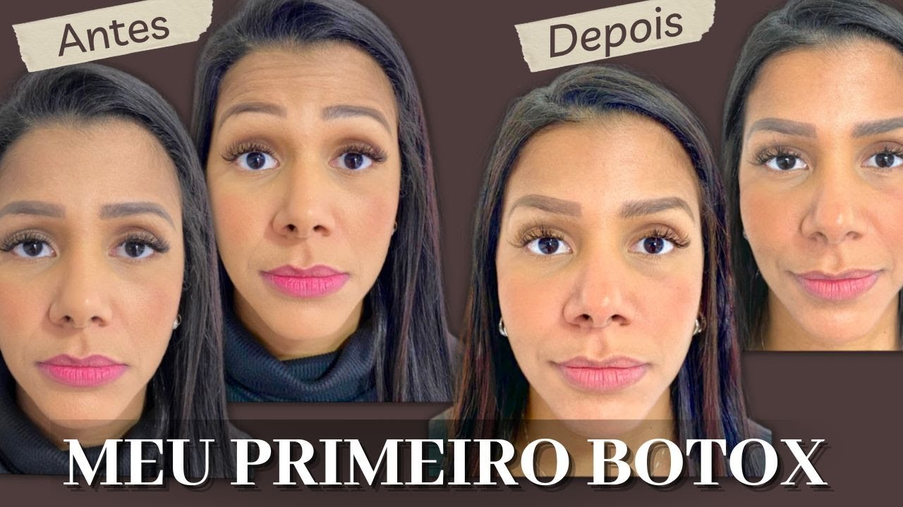 MEU PRIMEIRO BOTOX | ANTES, DEPOIS E RESULTADO DEFINITIVO | SOLUÇÃO PARA LINHAS DE EXPRESSÃO