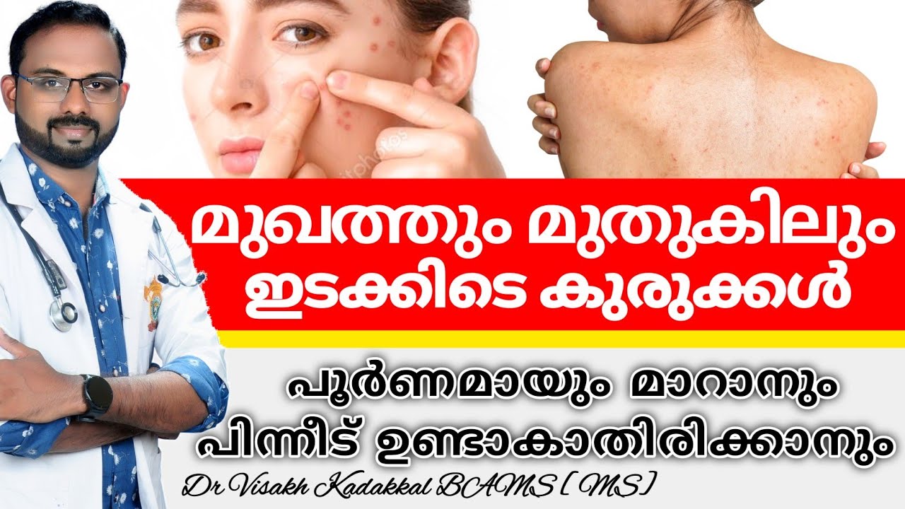 How to get rid of pimples in face / pimple marks on shoulders and back naturally in malayalam