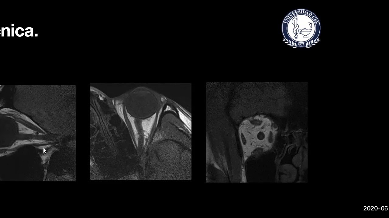 ANATOMIA RADIOLOGICA DE ORBITA  DR JOHN GONZALEZ.  2020/5/29