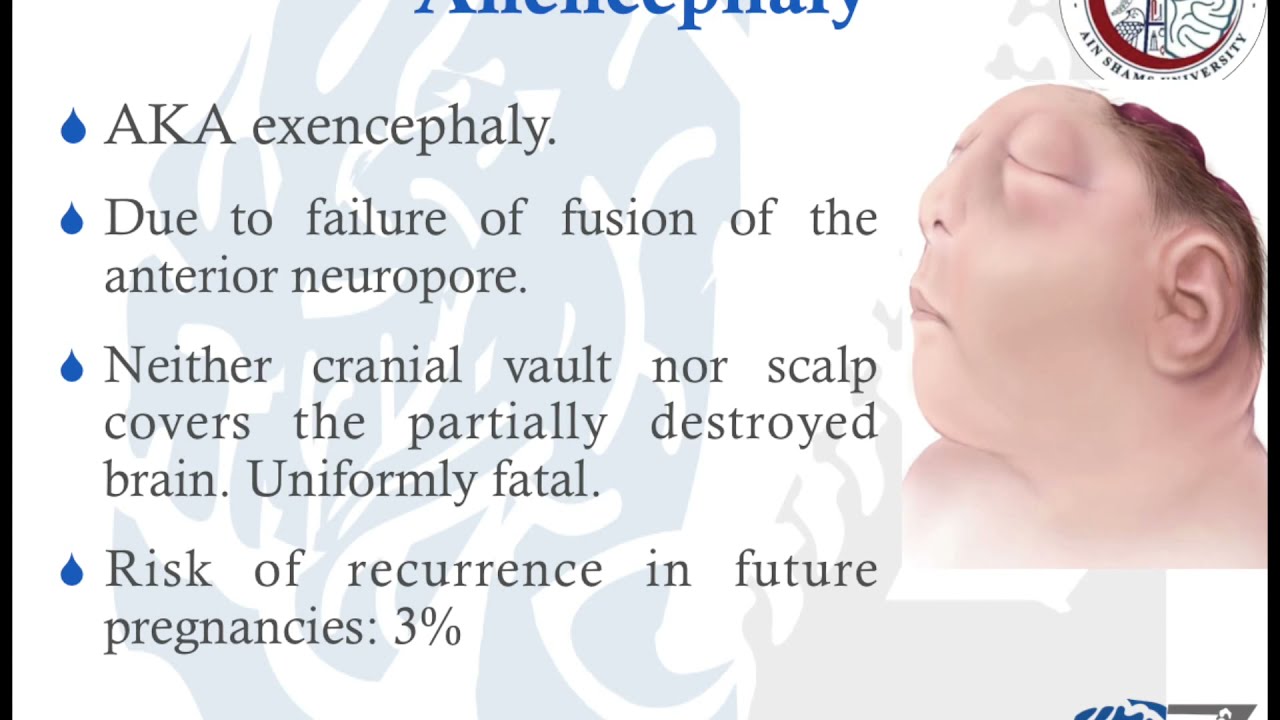 Neural Tube Defects: Neurolation Defects: