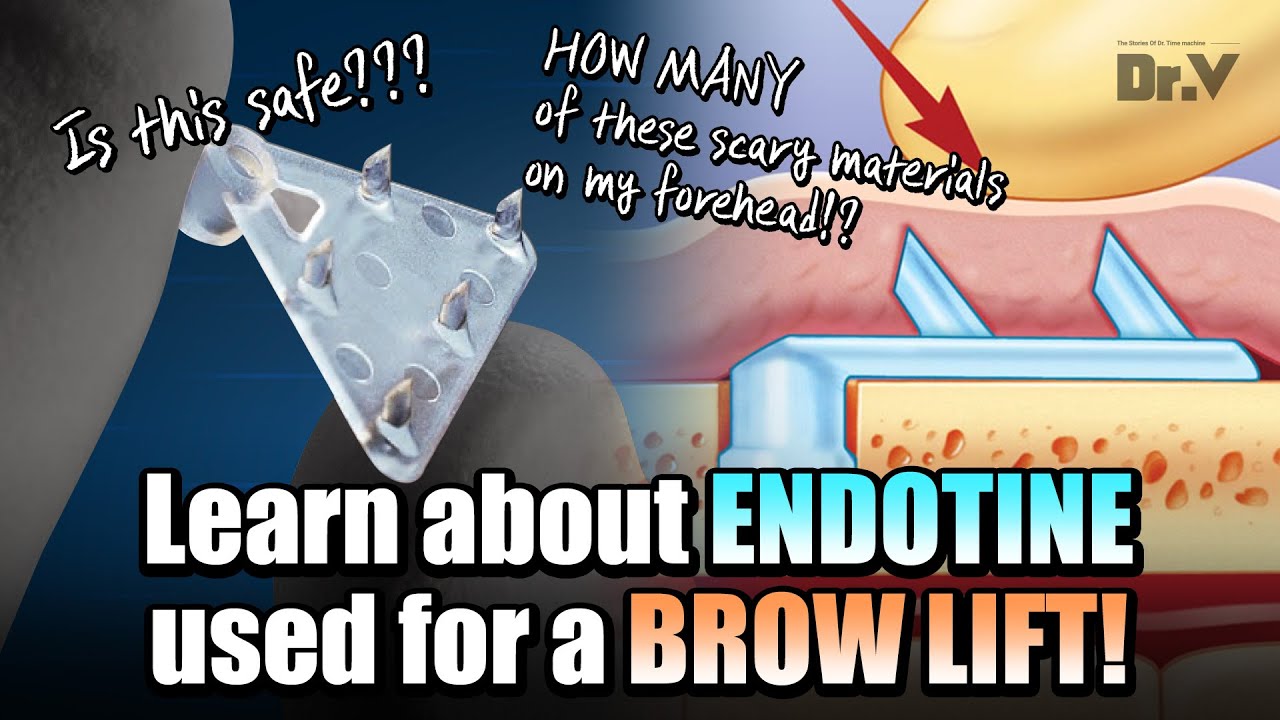 Facelift FAQ) How many Endotines are needed for a forehead lift?