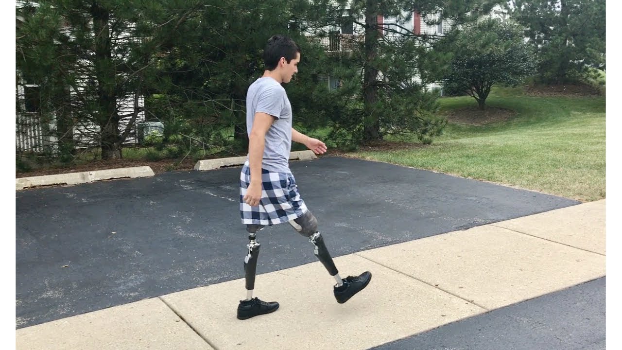 Bilateral Above Knee Daily Activities (Vidalito)