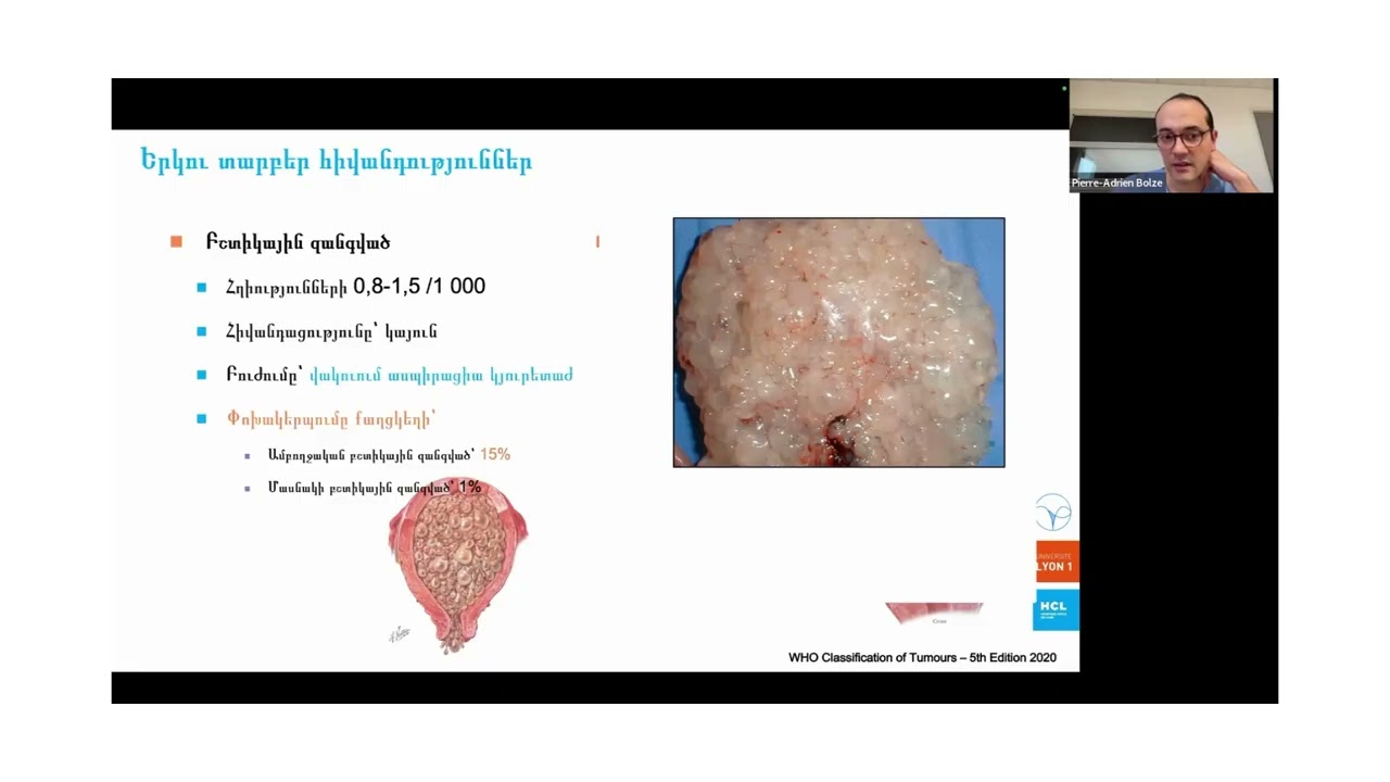 REPLAY du cours du 12/02/26  : Maladie trophoblastique gestationnelle - Pr Pierre-Adrien BOLZE