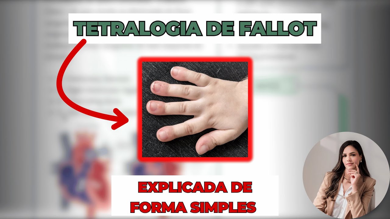 🫀 Tetralogia de Fallot Explicada de Forma Simples (NCLEX e Prática Clínica) 💉
