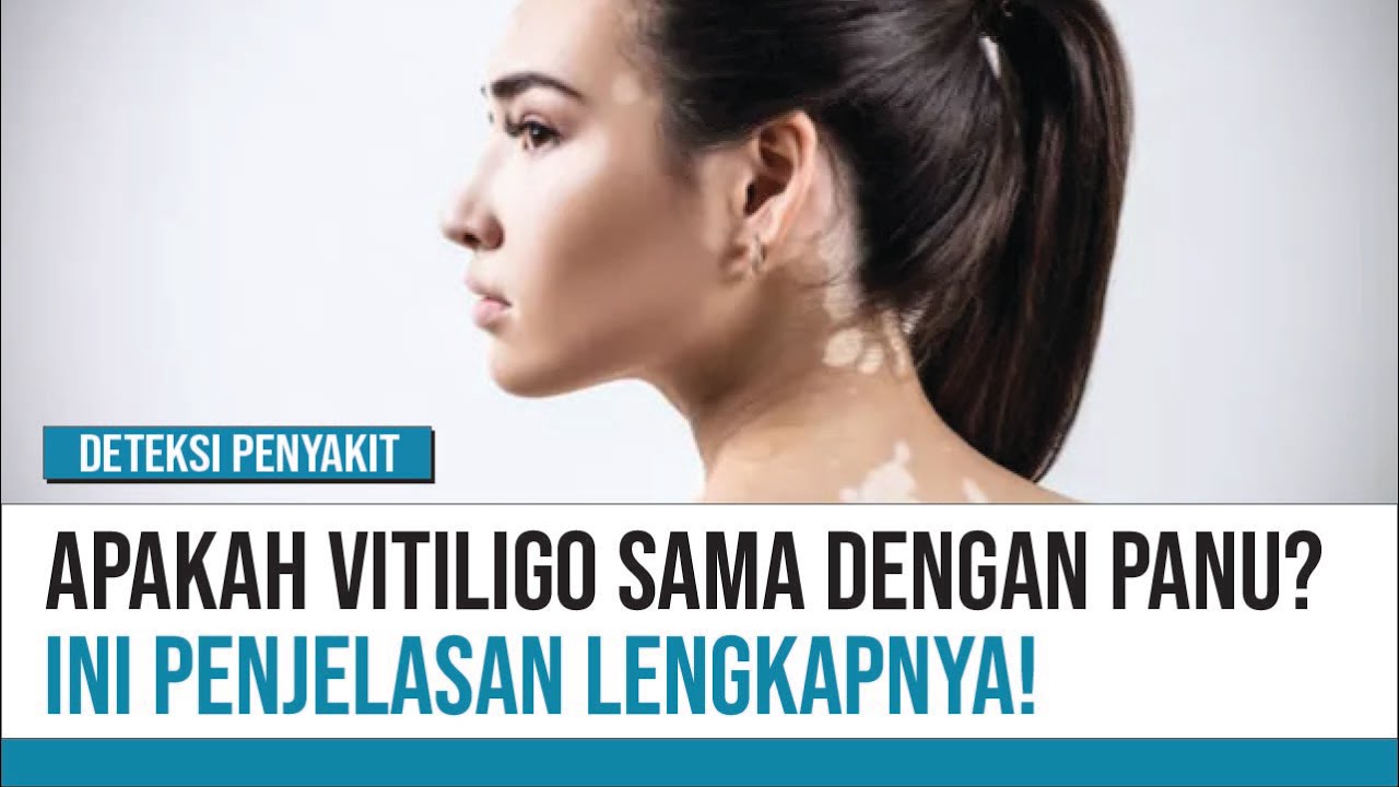 Bercak Putih di Tubuh, Panu atau Vitiligo? | Deteksi Penyakit