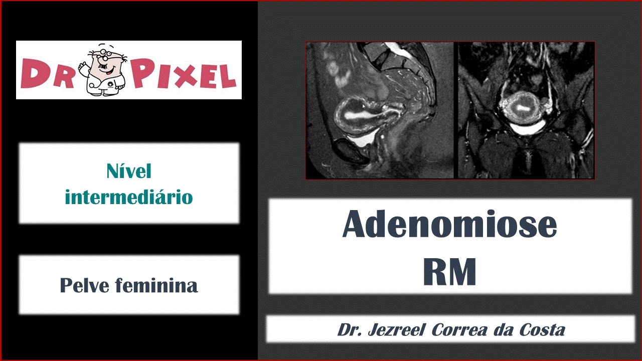 Adenomiose pela RM