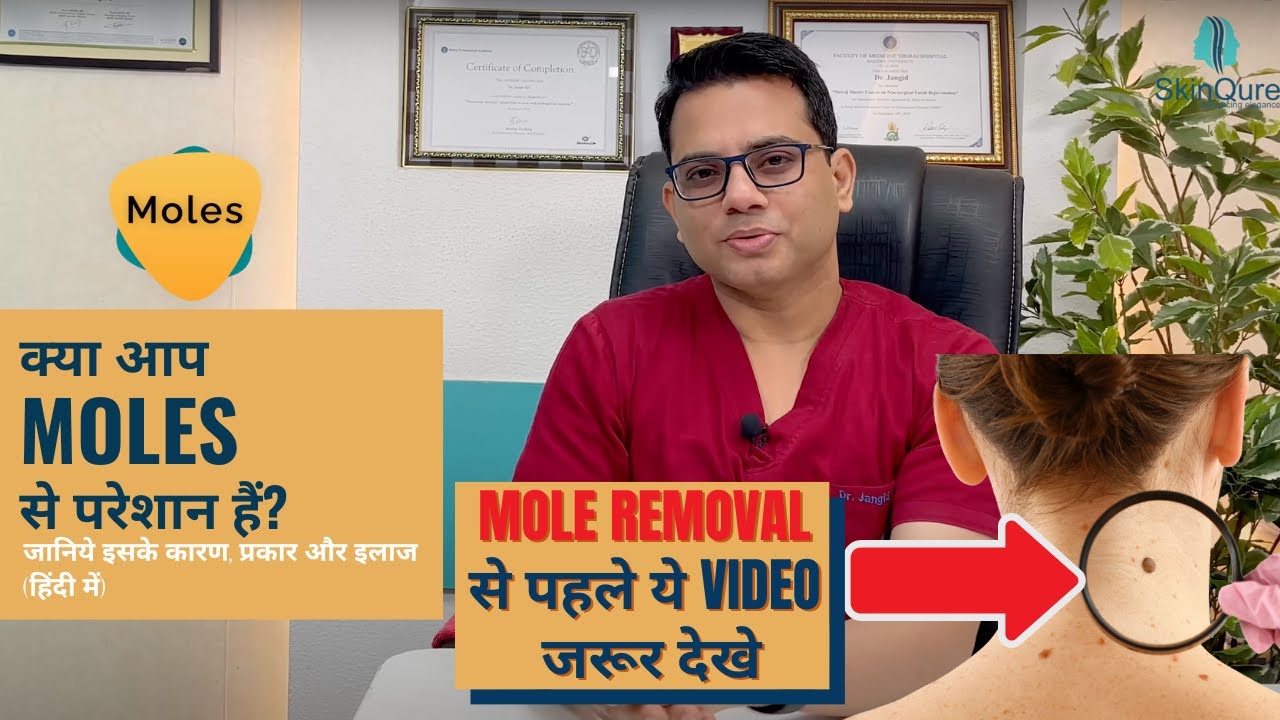 Best Mole Treatment | Laser or Surgery for Mole removal  in Delhi | Dr Jangid | SkinQure Clinic