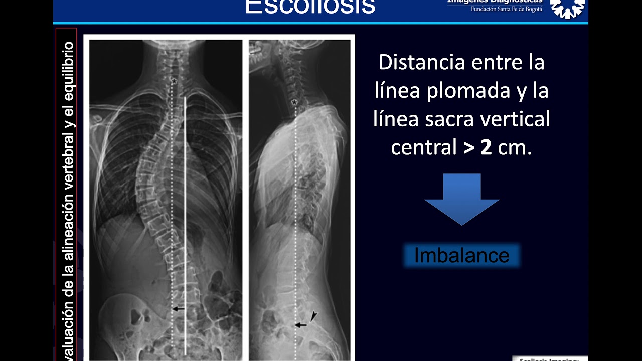 Medidas en escoliosis.
