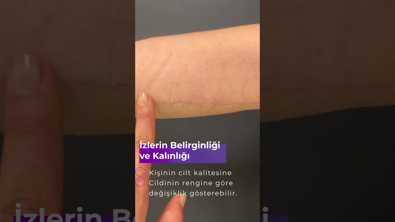 Kol Germe Ameliyatı Sonrası 3.Hafta