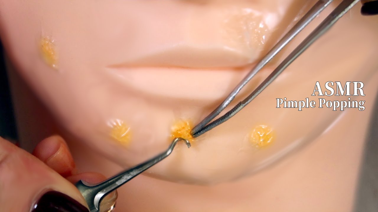 ☾ASMR 쾌감 있는 여드름 압출 l 여드름 압출 장인ASMR l 피부과RP l Pimple Popping l Skin Care RP