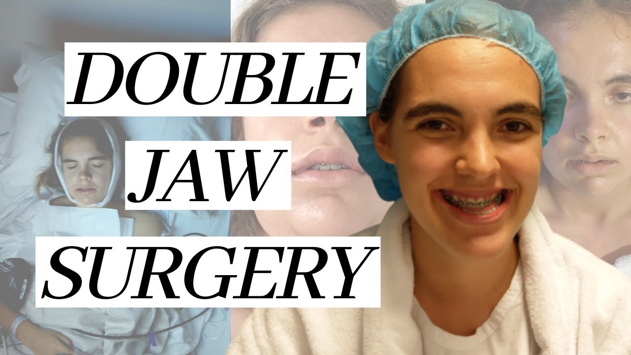 I Had Double Jaw Surgery