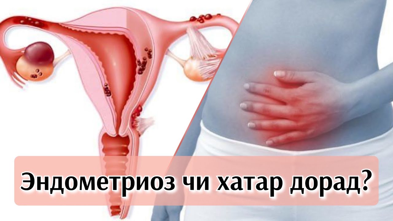 Эндометриоз, аденомиоз, методы профилактики и лечения. #эндометриоз #аденомиоз #здороваяжизнь