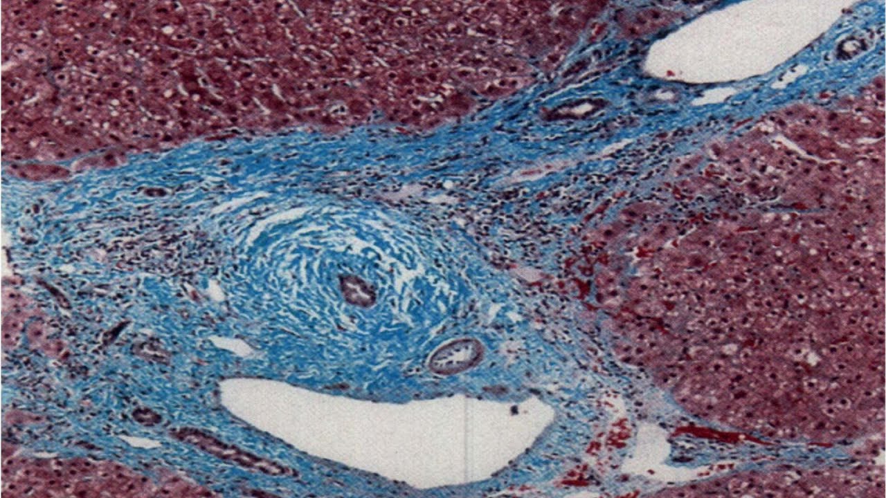 Hígado y sistema inmunológico IV: Colangitis esclerosante primaria - Dr. Miguel Garassini