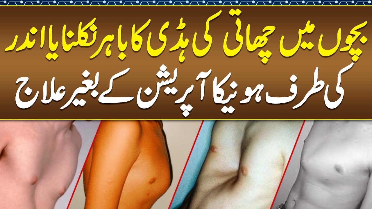 Senay ki hadi Ka ilaj- Pigeon Chest Causes, Treatment & Surgery- Pectus Excavatum & Pectus Carinatum