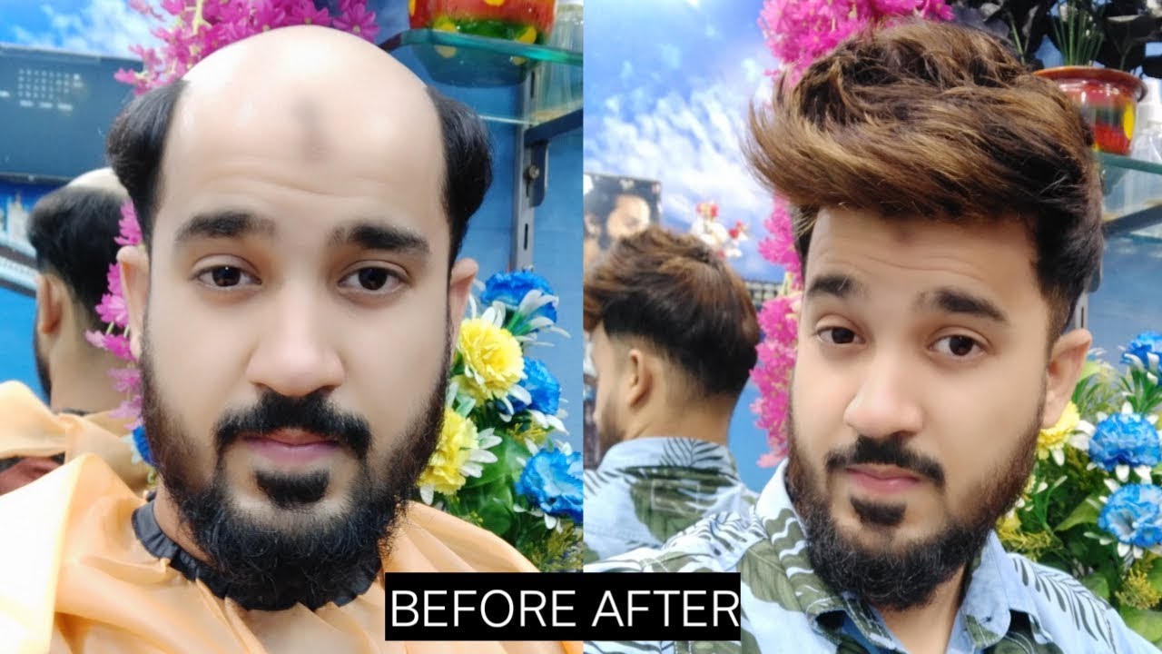 Taping method hair patch system in Delhi, by anas sheikh, call us 9650914665 whatsap also