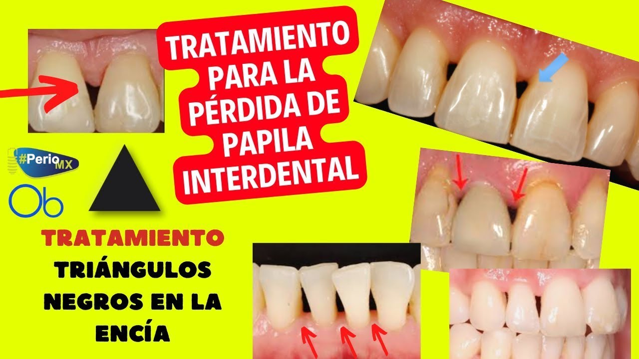 Tratamiento para la pérdida de Papila interdental 🦷 ▲ TRIÁNGULOS NEGROS EN LA ENCÍA con @periomx