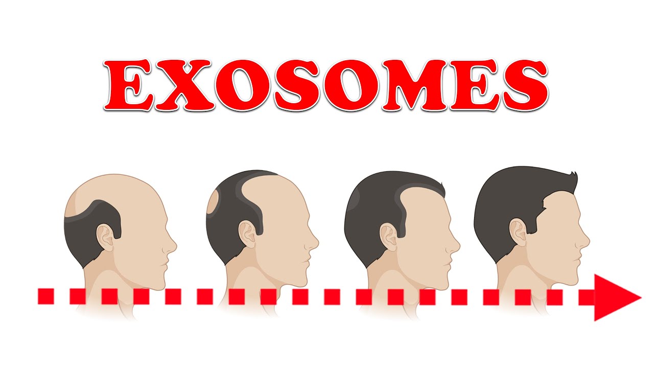 EXOSOMAS para RECUPERACIÓN de PELO