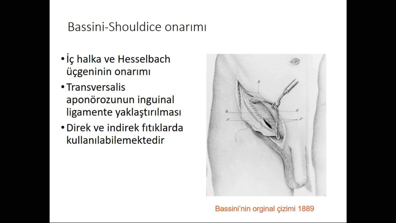 Karın Duvarı Fıtıkları