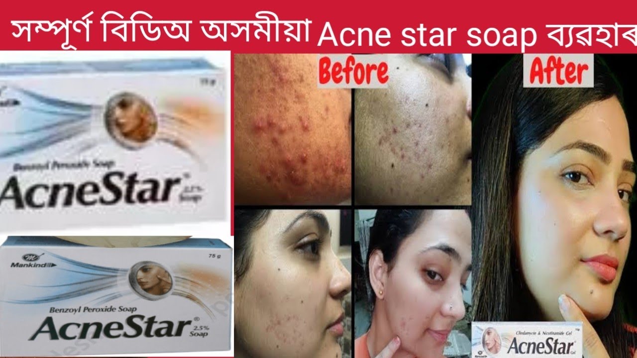 acne star soap full review in Assamese.use dose price and side effects.plz subscribe this channel.