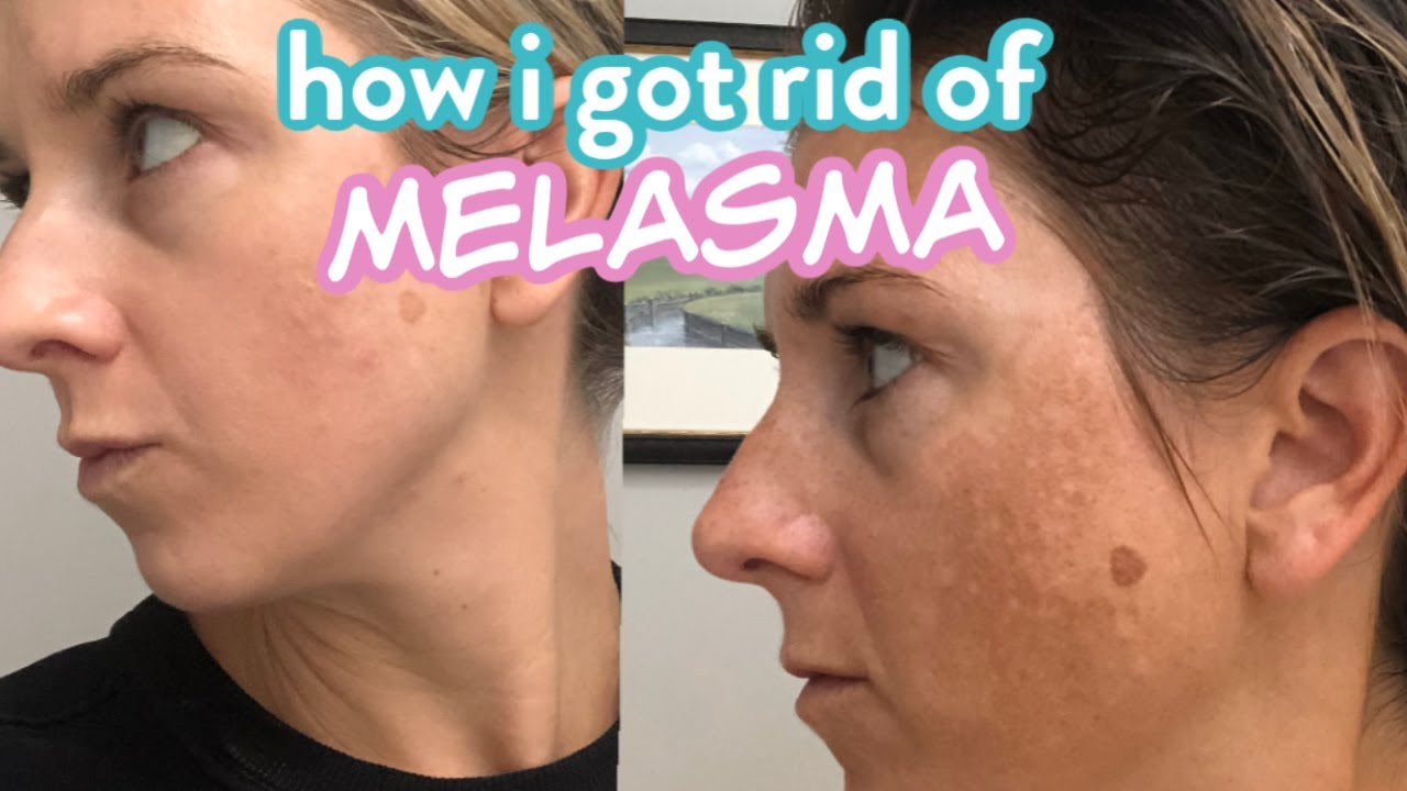 How I Got Rid of my Melasma aka Pregnancy Dark Spot