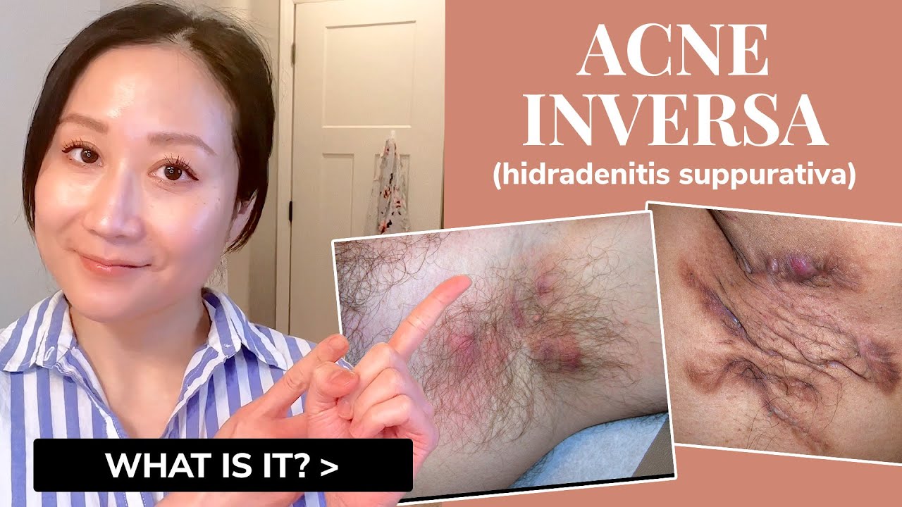 Dermatologist explains ACNE INVERSA | Hidradenitis Suppurativa (HS)