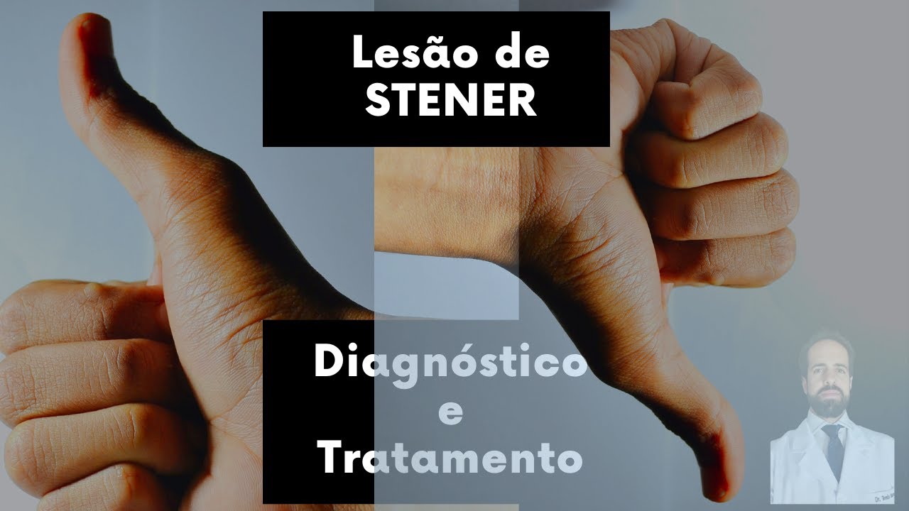 Lesão de Stener - Diagnóstico e Tratamento