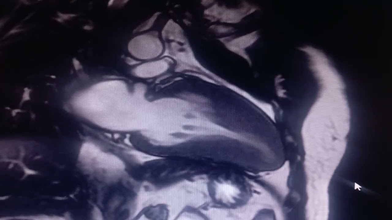 Yamaguchi apical HCM