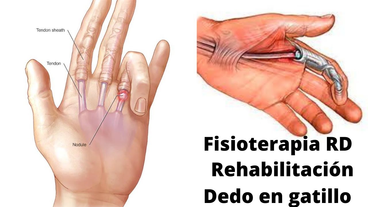 Los mejores ejercicios para el Dedo en gatillo.- Fisioterapia RD.