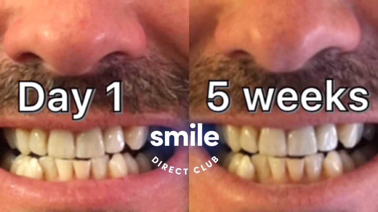 SmileDirectClub - Week 5 update (with comparison pictures & promo code)