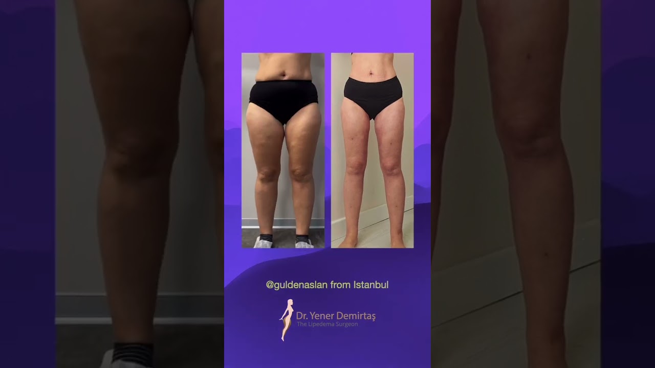 2-Month Result After 8L Fat Removal &ndash; Lipedema Surgery