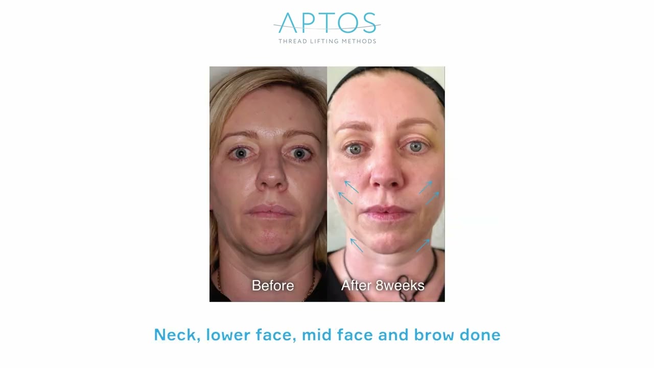 Aptos Thread Lift Visage Excellent Method