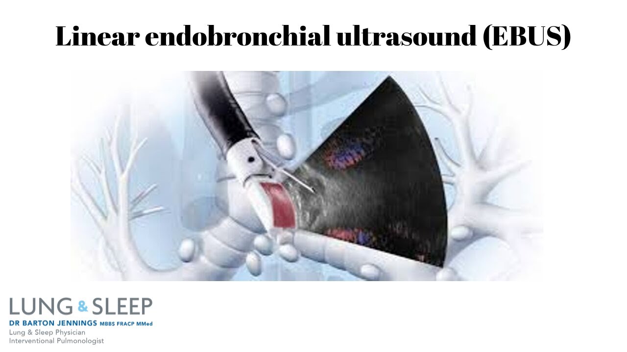 Linear endobronchial ultrasound (EBUS) bronchoscopy demonstration