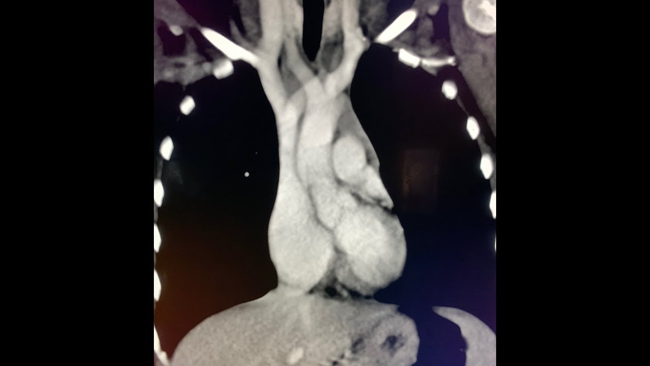 Correct positioning of a central line