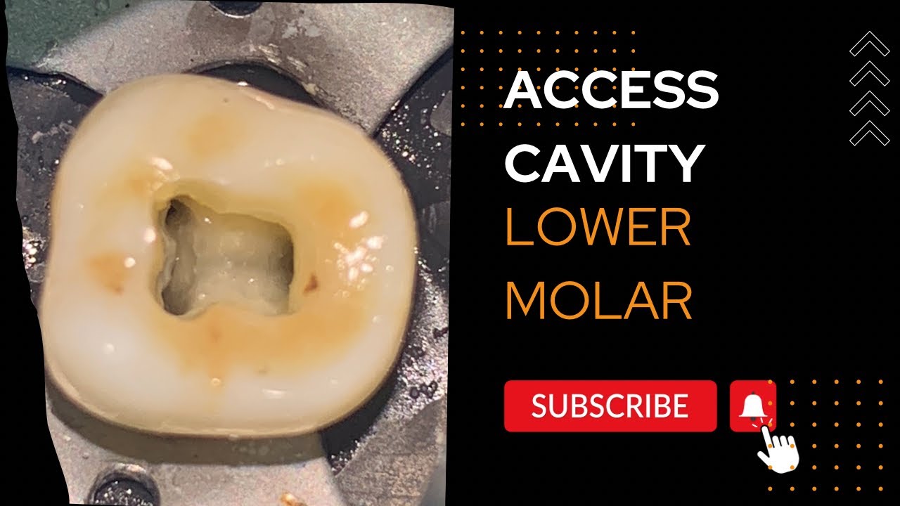 Calcified Lower Molar Access Opening
