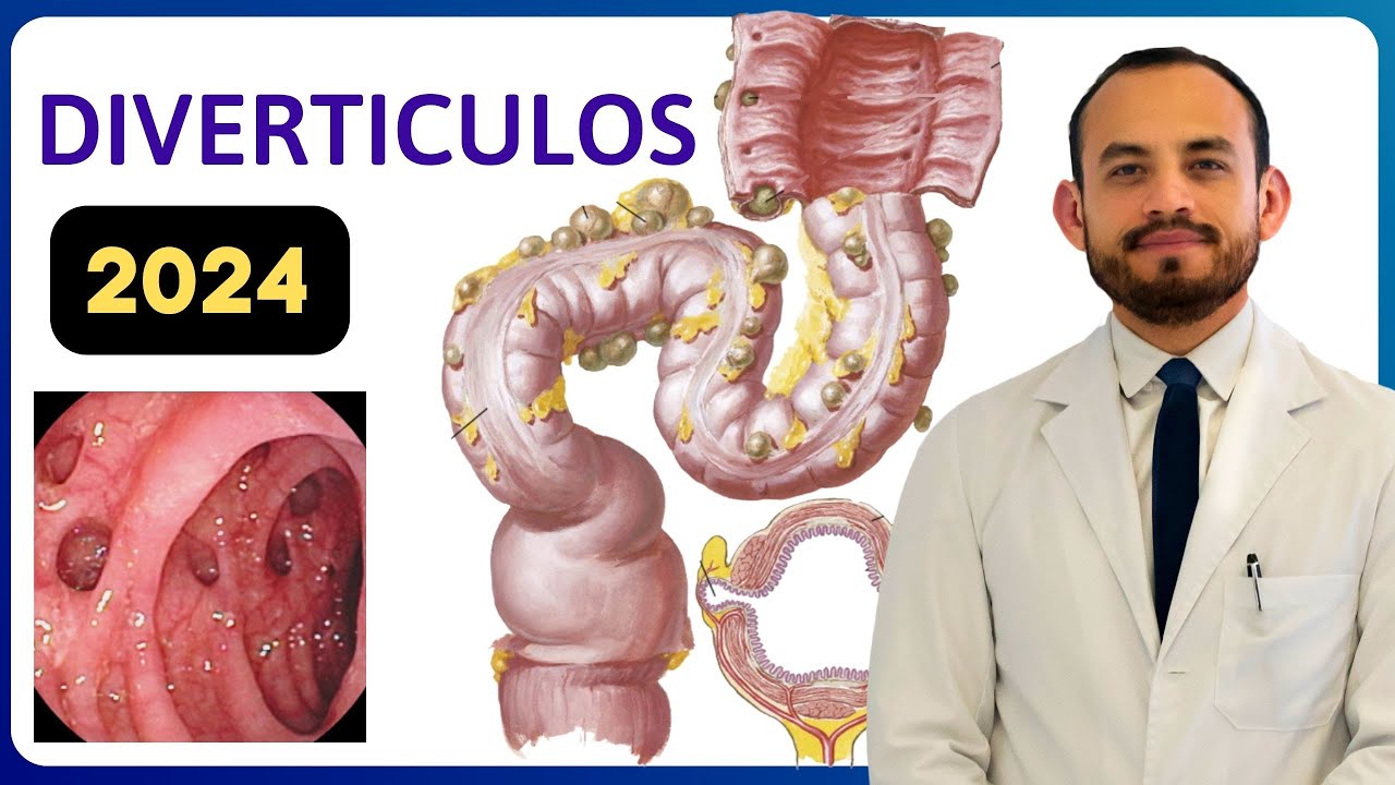 🔴 Qu&eacute; son los 𝐃𝐢𝐯𝐞𝐫𝐭𝐢́𝐜𝐮𝐥𝐨𝐬 𝐝𝐞𝐥 𝐂𝐨𝐥𝐨𝐧? (Para M&eacute;dicos)