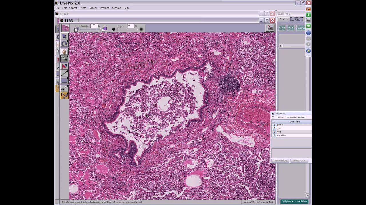 Medical School Pathology, 2013 Season, Session #58: Lung-IV and Lab