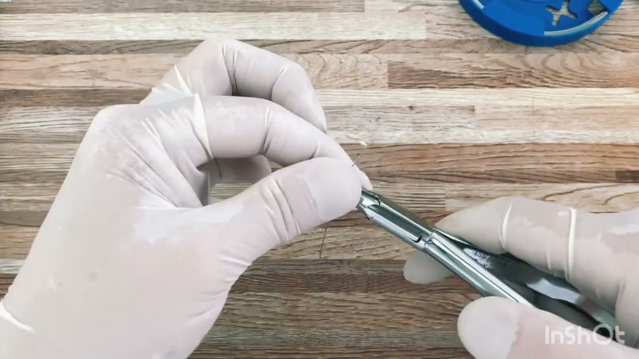 UNHA_ENCRAVADA (confecção de órtese) ÔMEGA #unhaencravada #nails #podologia