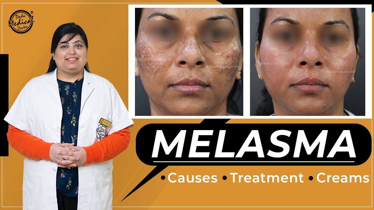 How to treat MELASMA - Treat DARK SPOTS & PATCHES on the skin | Causes & Best Creams of Melasma