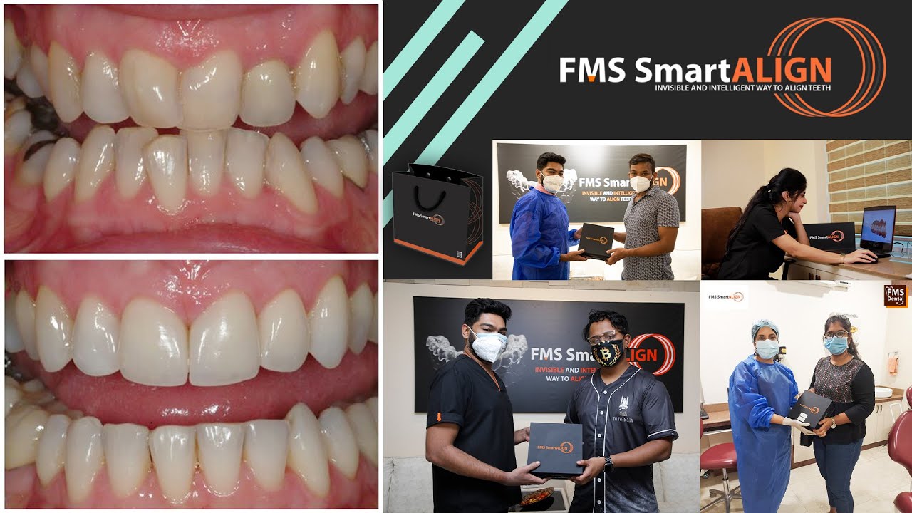 FMS SmartAlign | Designed and Delivered By Orthodontists |Aligners for Teeth correction| FMS Dental