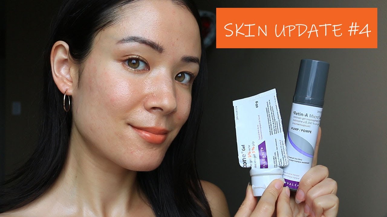 SKIN UPDATE [#4]: Adapalene (Differin) to Tretinoin (Retin-A Micro), Taking Spironolactone