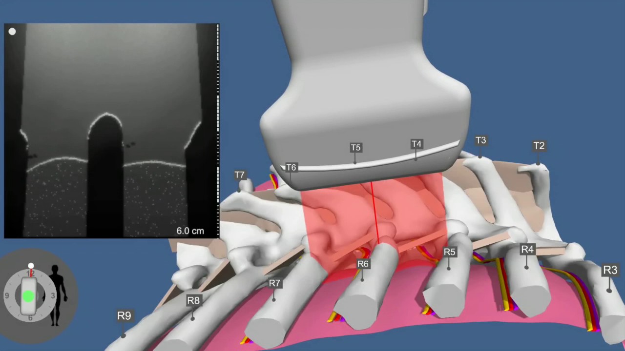 Ultrasound Assisted Thoracic Paravertebral Nerve Block Part 1