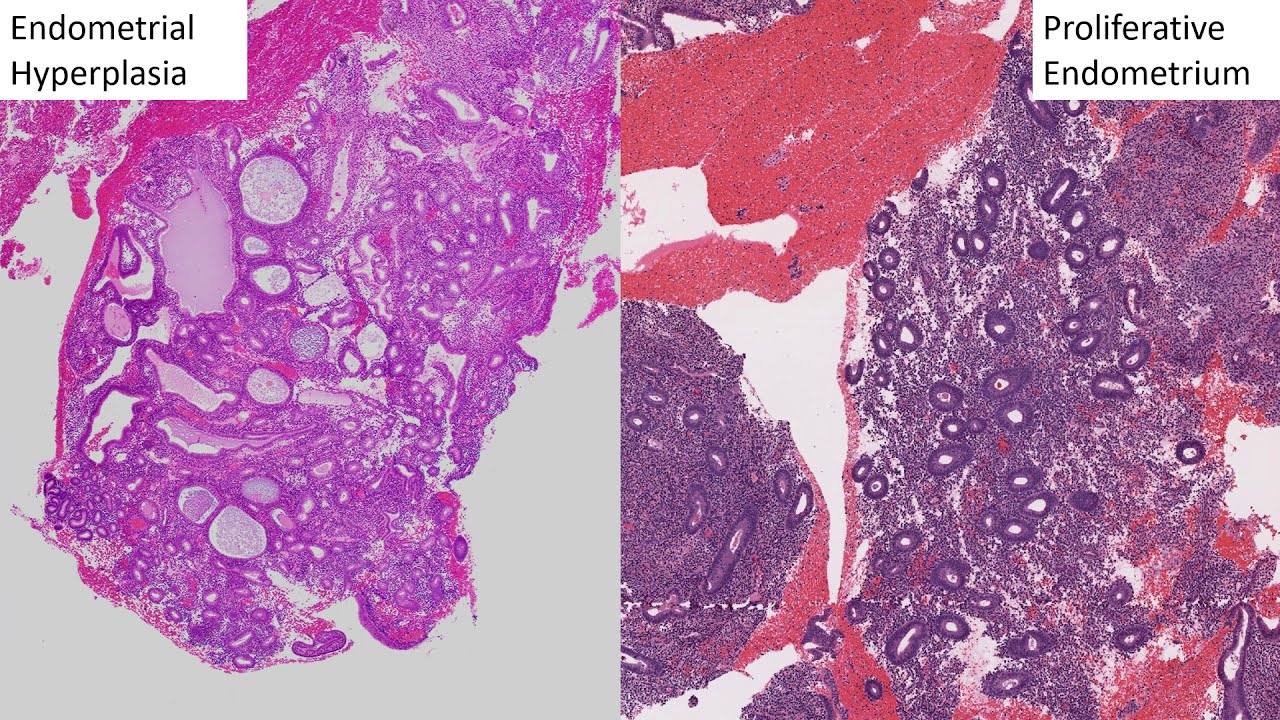 GYN Pathology Basics: Endometrial Hyperplasia to Endometrioid Adenocarcinoma