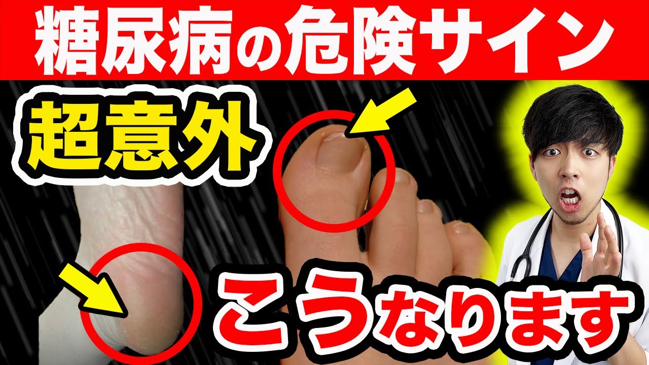 【放置厳禁】知らないと後悔する糖尿病『足』のSOSサイン【注意な合併症】初期症状を現役医師が簡単解説します。